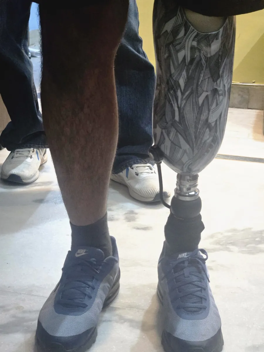 Below-knee prostheses fitted at P.O.R.C, Delhi NCR